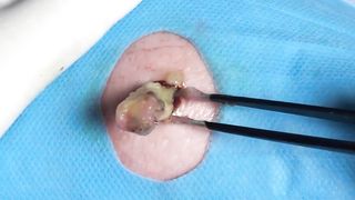 BEST Pimple Popping __ Big Cystic Acne Blackheads __ Whiteheads Removal _ Squeezing Pimples _ H#075 - 004