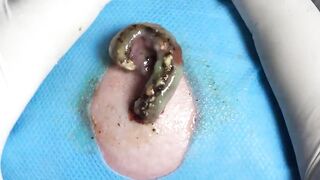BEST Pimple Popping __ Big Cystic Acne Blackheads __ Whiteheads Removal _ Squeezing Pimples _ H#075 - 008