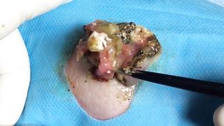 BEST Pimple Popping __ Big Cystic Acne Blackheads __ Whiteheads Removal _ Squeezing Pimples _ H#075 - 009