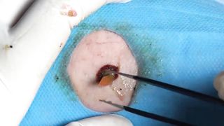 BEST Pimple Popping __ Big Cystic Acne Blackheads __ Whiteheads Removal _ Squeezing Pimples _ H#075 - 011