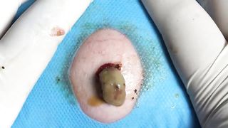 BEST Pimple Popping __ Big Cystic Acne Blackheads __ Whiteheads Removal _ Squeezing Pimples _ H#075 - 012