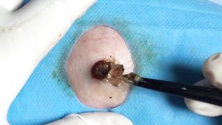 BEST Pimple Popping __ Big Cystic Acne Blackheads __ Whiteheads Removal _ Squeezing Pimples _ H#075 - 013