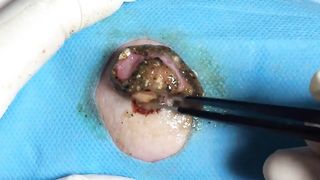 BEST Pimple Popping __ Big Cystic Acne Blackheads __ Whiteheads Removal _ Squeezing Pimples _ H#075 - 014