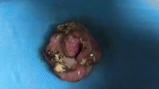 BEST Pimple Popping __ Big Cystic Acne Blackheads __ Whiteheads Removal _ Squeezing Pimples _ H#075 - 015