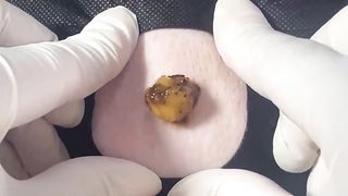 BEST Pimple Popping __ Big Cystic Acne Blackheads __ Whiteheads Removal _ Squeezing Pimples _ H#086 - 001