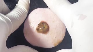 BEST Pimple Popping __ Big Cystic Acne Blackheads __ Whiteheads Removal _ Squeezing Pimples _ H#086 - 002
