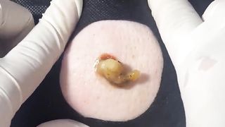 BEST Pimple Popping __ Big Cystic Acne Blackheads __ Whiteheads Removal _ Squeezing Pimples _ H#086 - 004