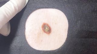 BEST Pimple Popping __ Big Cystic Acne Blackheads __ Whiteheads Removal _ Squeezing Pimples _ H#086 - 003