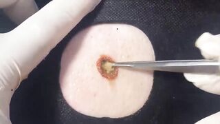 BEST Pimple Popping __ Big Cystic Acne Blackheads __ Whiteheads Removal _ Squeezing Pimples _ H#086 - 007