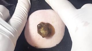 BEST Pimple Popping __ Big Cystic Acne Blackheads __ Whiteheads Removal _ Squeezing Pimples _ H#086 - 008
