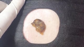 BEST Pimple Popping __ Big Cystic Acne Blackheads __ Whiteheads Removal _ Squeezing Pimples _ H#086 - 009