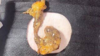 BEST Pimple Popping __ Big Cystic Acne Blackheads __ Whiteheads Removal _ Squeezing Pimples _ H#086 - 008