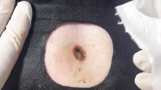 BEST Pimple Popping __ Big Cystic Acne Blackheads __ Whiteheads Removal _ Squeezing Pimples _ H#086 - 011
