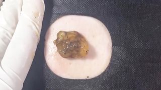 BEST Pimple Popping __ Big Cystic Acne Blackheads __ Whiteheads Removal _ Squeezing Pimples _ H#086 - 012
