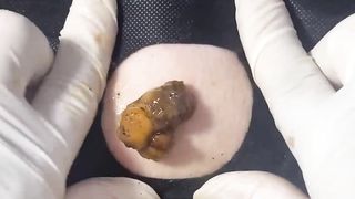 BEST Pimple Popping __ Big Cystic Acne Blackheads __ Whiteheads Removal _ Squeezing Pimples _ H#086 - 013
