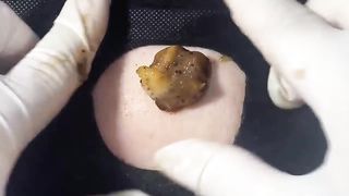 BEST Pimple Popping __ Big Cystic Acne Blackheads __ Whiteheads Removal _ Squeezing Pimples _ H#086 - 014