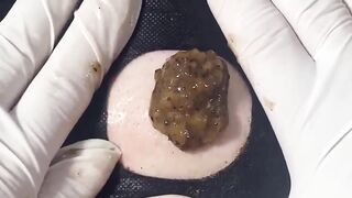 BEST Pimple Popping __ Big Cystic Acne Blackheads __ Whiteheads Removal _ Squeezing Pimples _ H#086 - 015