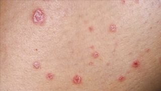 Psoriasis Treatment – The Best 3 Remedies for Psoriasis – Dr.Berg