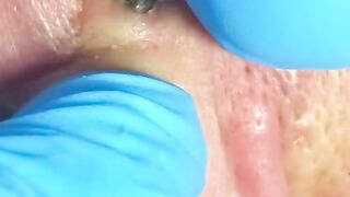 big blackhead