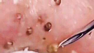 The most clear blackhead