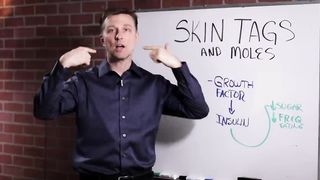 What Causes Skin Tags and Moles? – Dr.Berg