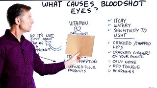 What Causes Bloodshot Eyes? – Dr.Berg
