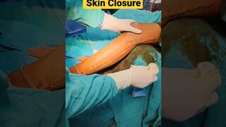Skin closure after surgery