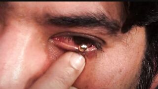 Pir Haq Khatib 2 pearls removed from patient's eye, another bust of