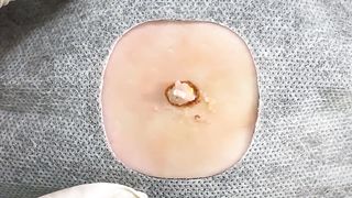 BEST Pimple Popping __ Big Cystic Acne Blackheads __ Whiteheads Removal _ Squeezing Pimples _ Hv#049 - 001