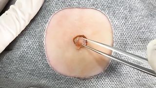 BEST Pimple Popping __ Big Cystic Acne Blackheads __ Whiteheads Removal _ Squeezing Pimples _ Hv#049 - 002