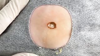 BEST Pimple Popping __ Big Cystic Acne Blackheads __ Whiteheads Removal _ Squeezing Pimples _ Hv#049 - 004