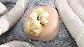 BEST Pimple Popping __ Big Cystic Acne Blackheads __ Whiteheads Removal _ Squeezing Pimples _ Hv#049 - 005