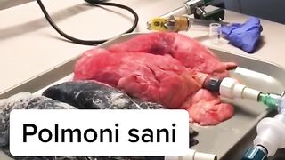 the difference between a normal person's lung and a smoker's lung