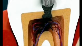 Root canal