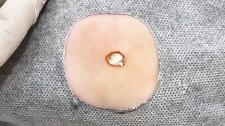 BEST Pimple Popping __ Big Cystic Acne Blackheads __ Whiteheads Removal _ Squeezing Pimples _ Hv#049 - 006