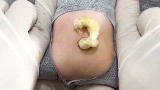 BEST Pimple Popping __ Big Cystic Acne Blackheads __ Whiteheads Removal _ Squeezing Pimples _ Hv#049 - 007
