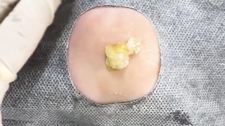 BEST Pimple Popping __ Big Cystic Acne Blackheads __ Whiteheads Removal _ Squeezing Pimples _ Hv#049 - 008
