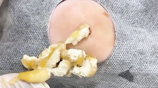 BEST Pimple Popping __ Big Cystic Acne Blackheads __ Whiteheads Removal _ Squeezing Pimples _ Hv#049 - 0010