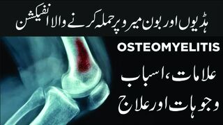 Osteomyelitis : causes, Symptoms, Diagnosis, and Treatment | Urdu/Hindi