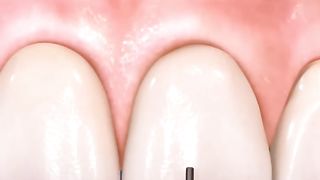 Cracked Front Tooth