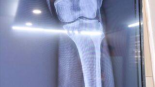 Knee pain treatment