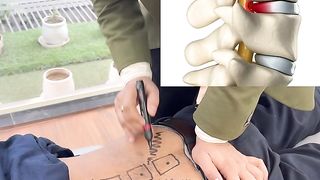 L4 - L5 disc bulge treatment