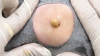 BEST Pimple Popping __ Big Cystic Acne Blackheads __ Whiteheads Removal _ Squeezing Pimples _ Hv#049 - 011