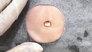 BEST Pimple Popping __ Big Cystic Acne Blackheads __ Whiteheads Removal _ Squeezing Pimples _ Hv#049 - 011