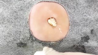 BEST Pimple Popping __ Big Cystic Acne Blackheads __ Whiteheads Removal _ Squeezing Pimples _ Hv#049 - 011