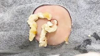 BEST Pimple Popping __ Big Cystic Acne Blackheads __ Whiteheads Removal _ Squeezing Pimples _ Hv#049 - 014