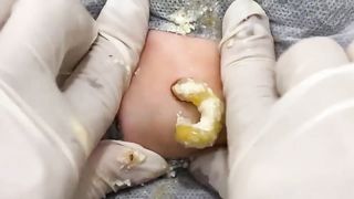BEST Pimple Popping __ Big Cystic Acne Blackheads __ Whiteheads Removal _ Squeezing Pimples _ Hv#049 - 015
