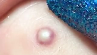 Big Blackheads Cystic Acne Blackheads&Whiteheads Removal Pimple Popping