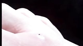 Pimple Popping & Blackheads