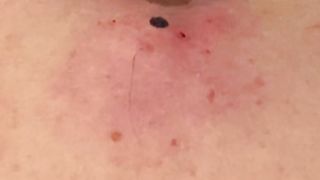 QUICK BACK POP _  PT 1  #pimplepopper